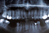 X-Ray of Teeth Knocked Out